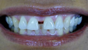 Front Teeth Gap thumbnail