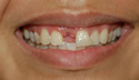 Implant thumbnail