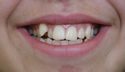 Teen Ortho thumbnail