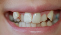 Crowded Teeth thumbnail