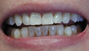 Before Veneers thumbnail