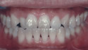 Adult Underbite thumbnail