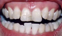 Misaligned/Veneers thumbnail