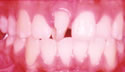 Rotated tooth thumbnail