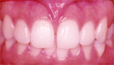 Deep overbite thumbnail