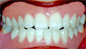 Open bite thumbnail